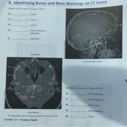 Identifying bones and bone markings on radiographs of skull