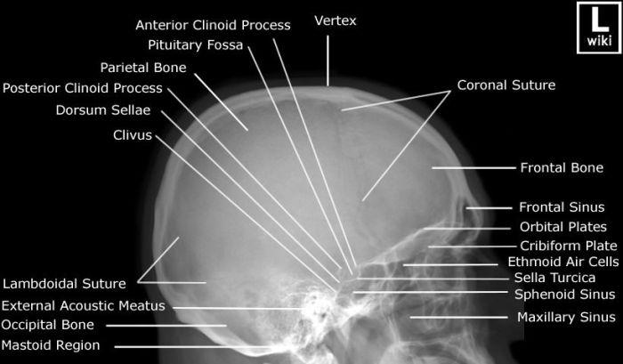 Skull lateral radiograph anteroposterior pricing netterimages