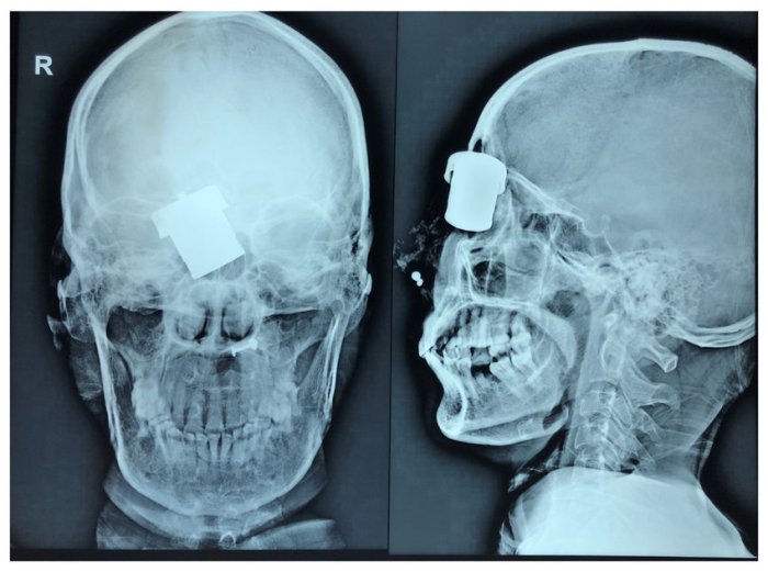 Bones skull facial